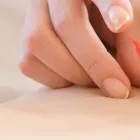 鍼灸